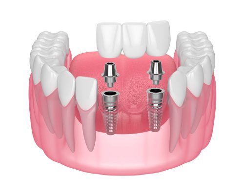 Jaw with implants supporting dental bridge over white background