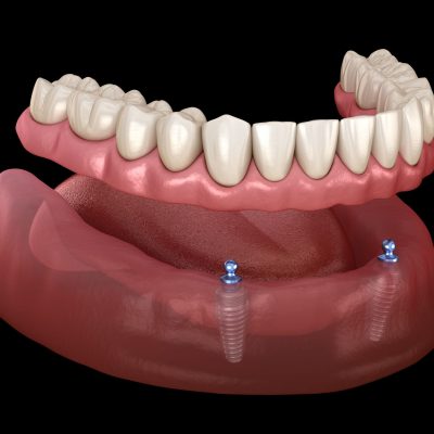 protesis sobre 2 implantes inferiores cc